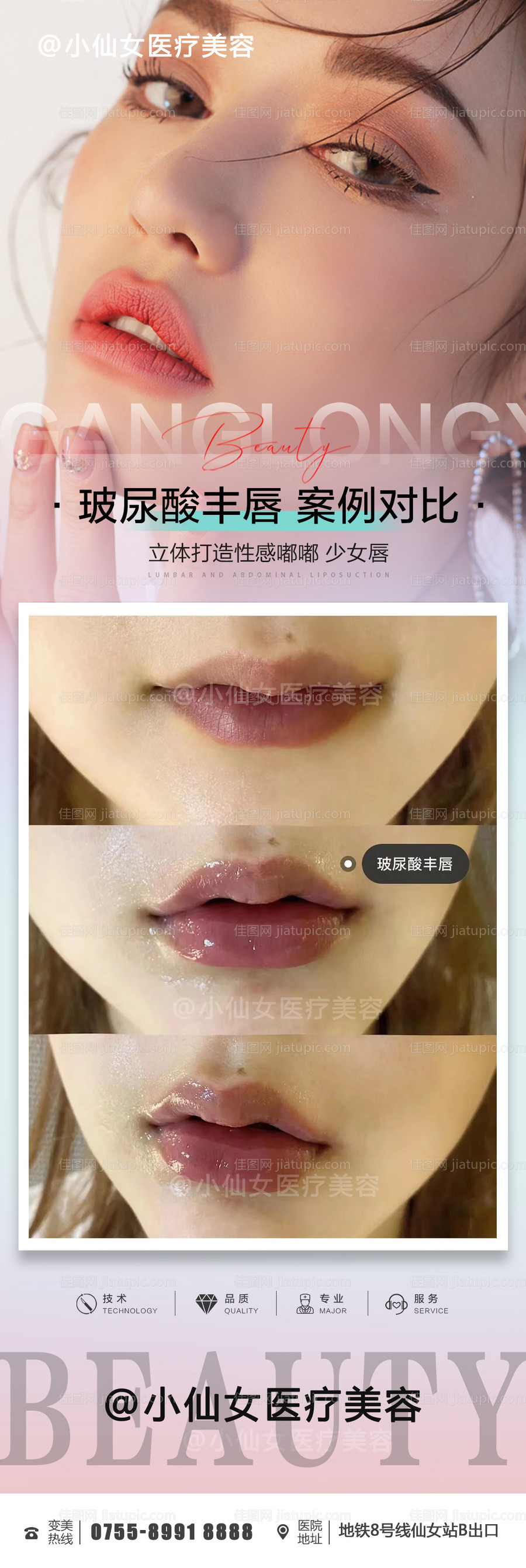 医美整形玻尿酸丰唇案例海报-源文件