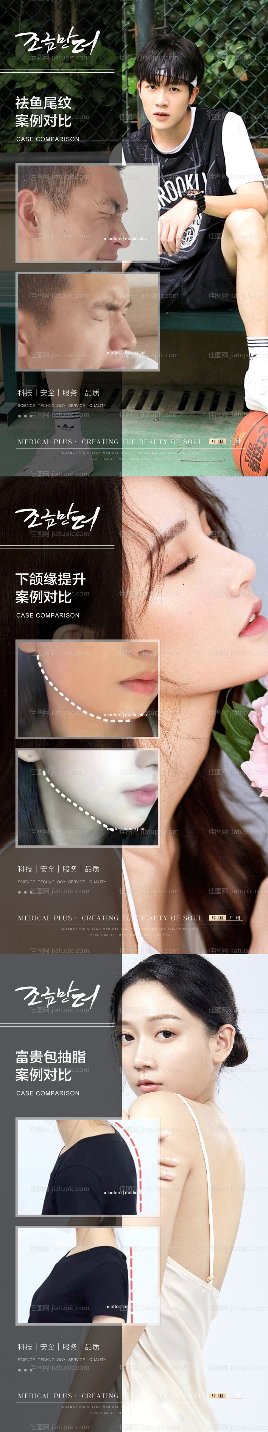 吸脂案例海报 -源文件