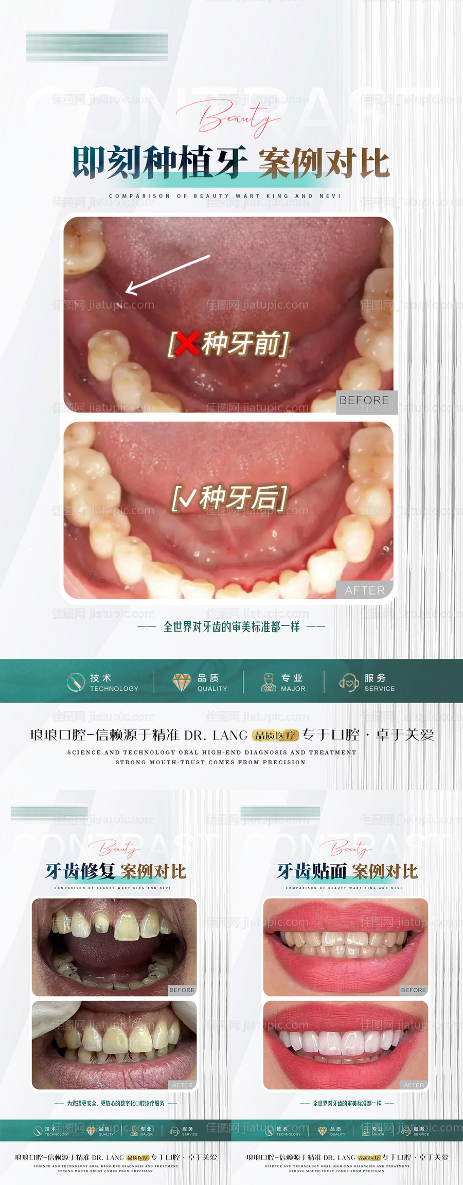 口腔贴面种植修复案例-源文件