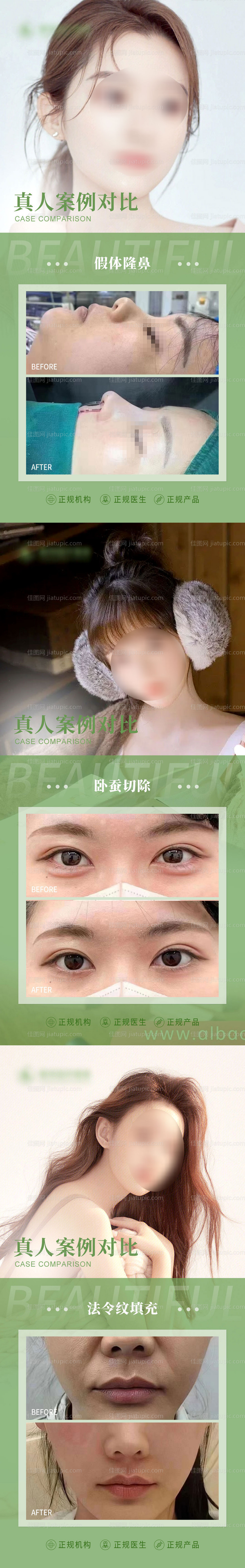 医美卧蚕填充案例海报-源文件