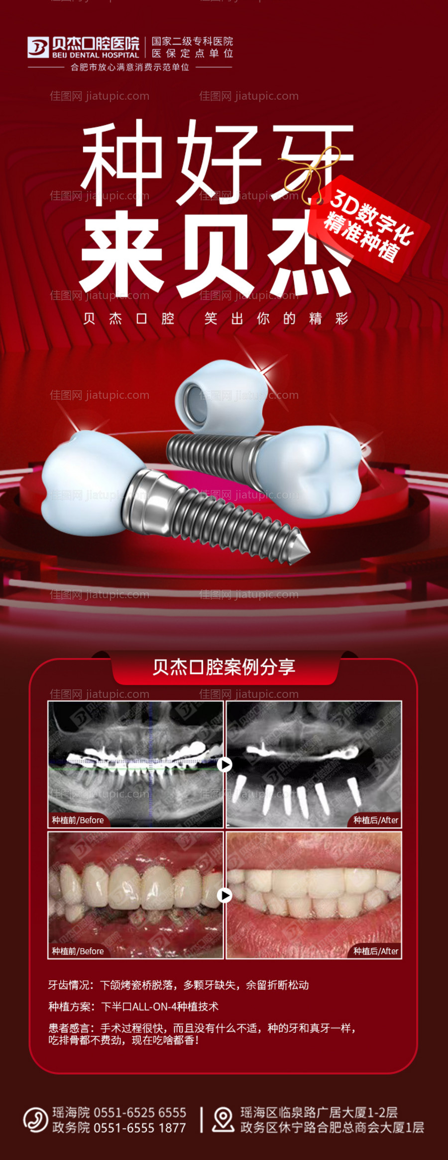 种植牙海报-源文件