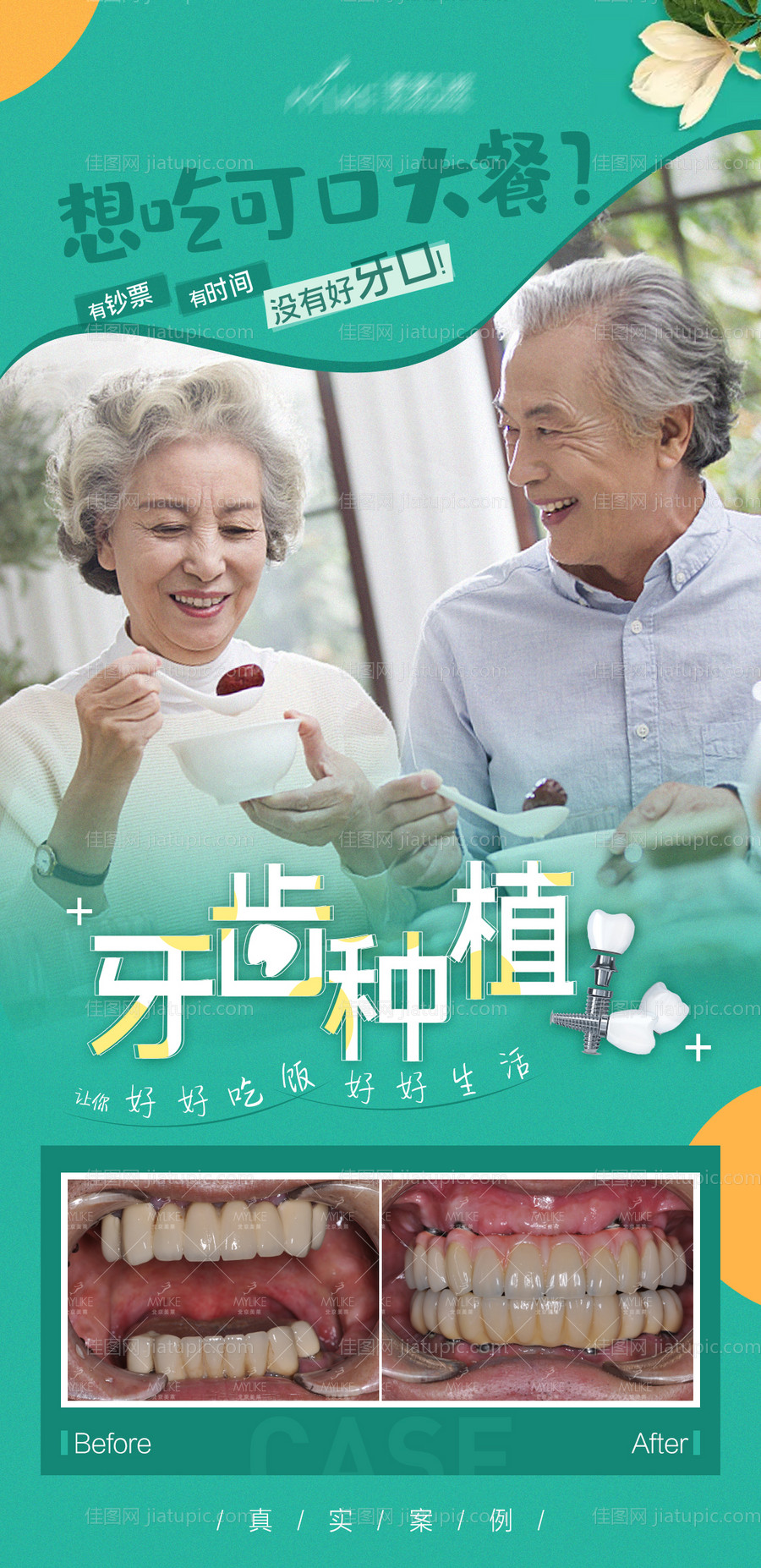 牙齿种植宣传海报-源文件