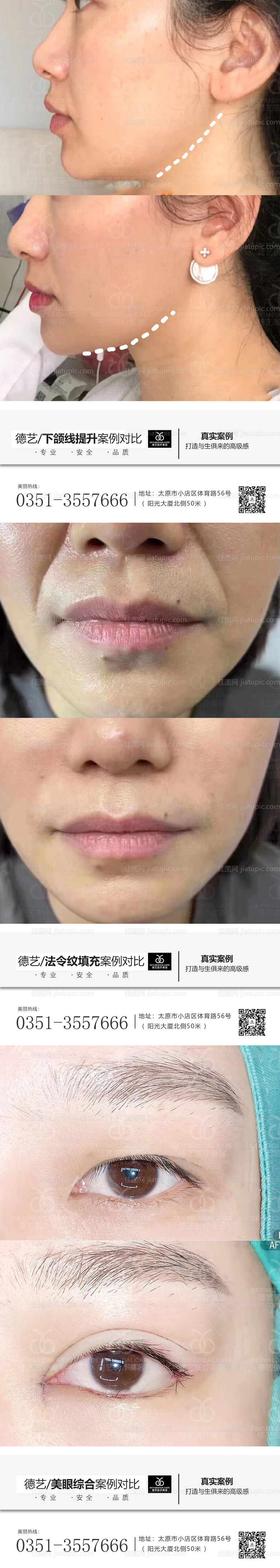 医美案例对比人物系列海报-源文件