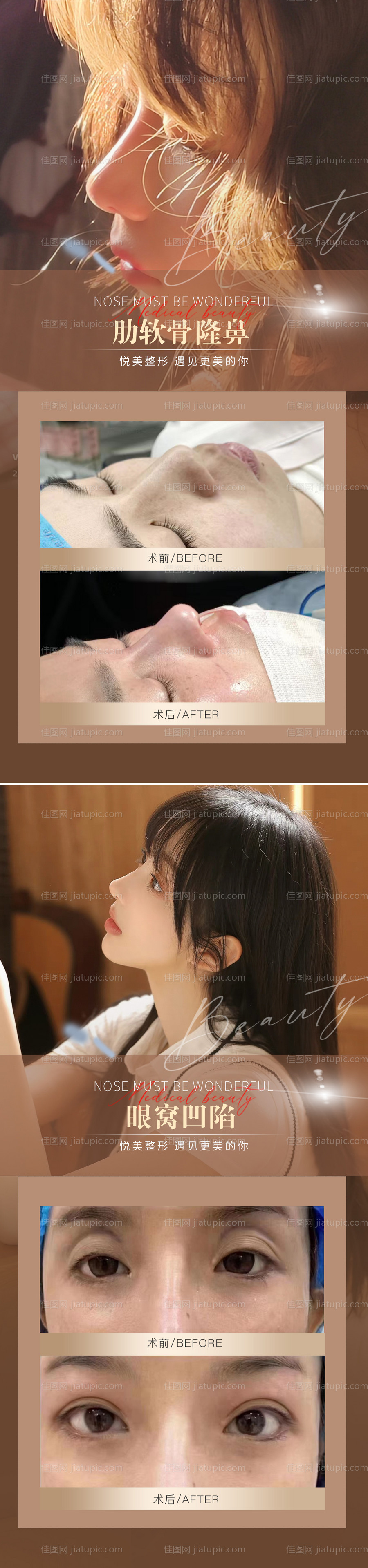 医美隆鼻双眼皮整形案例系列海报-源文件