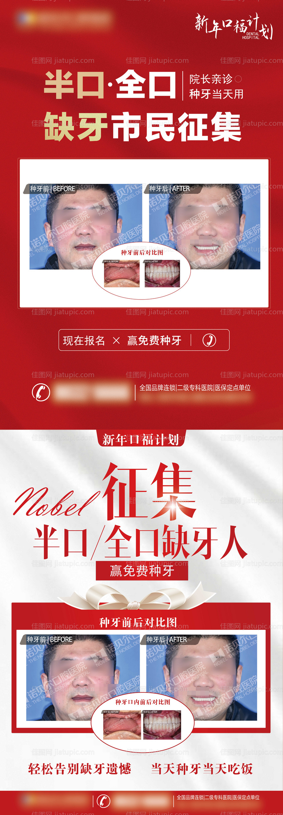 缺牙半口全口种植牙展架-源文件