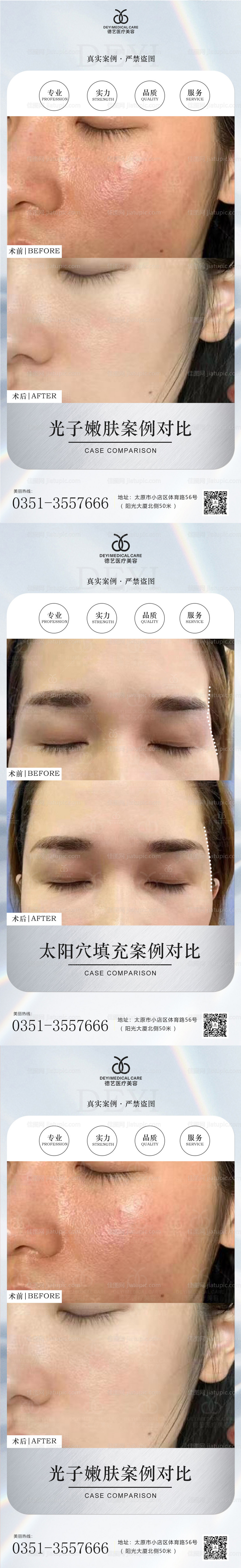 医美案例对比图-源文件