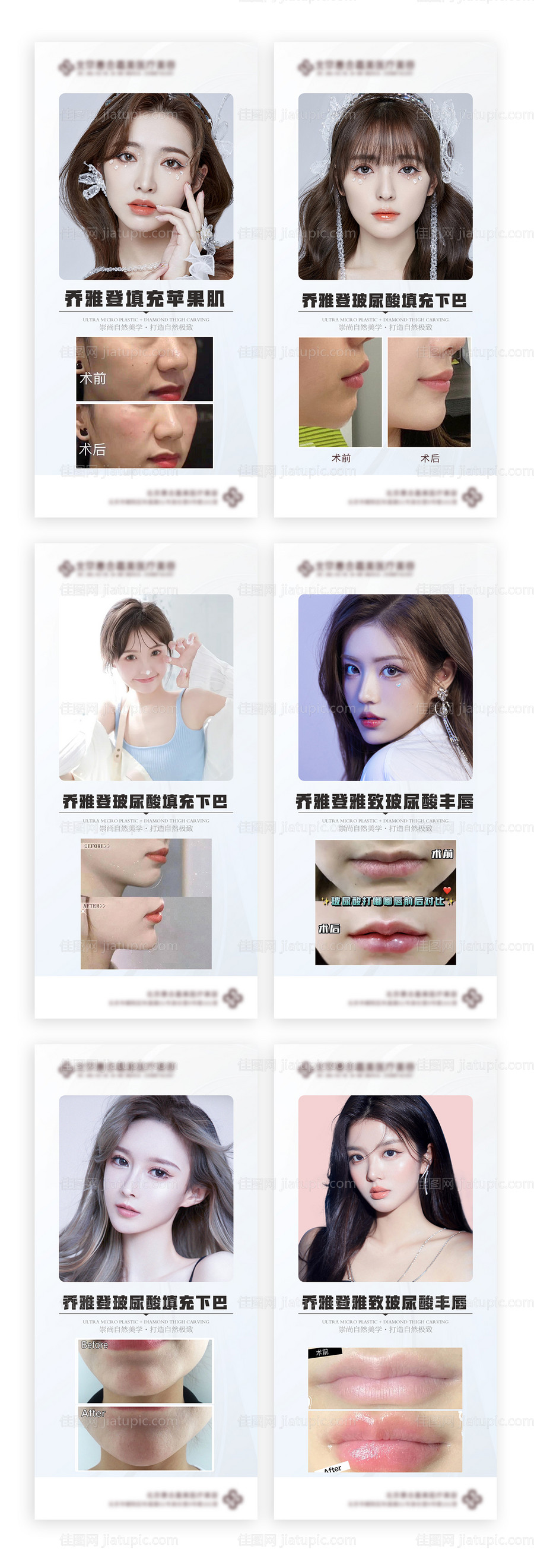 医美玻尿酸填充案例对比海报-源文件