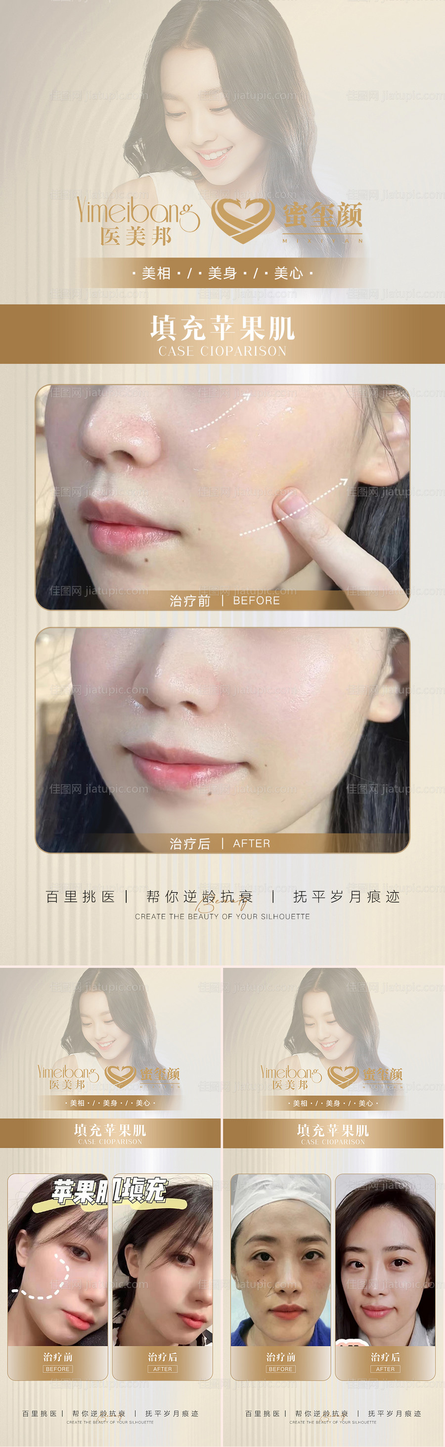 医美苹果肌案例对比图系列海报-源文件