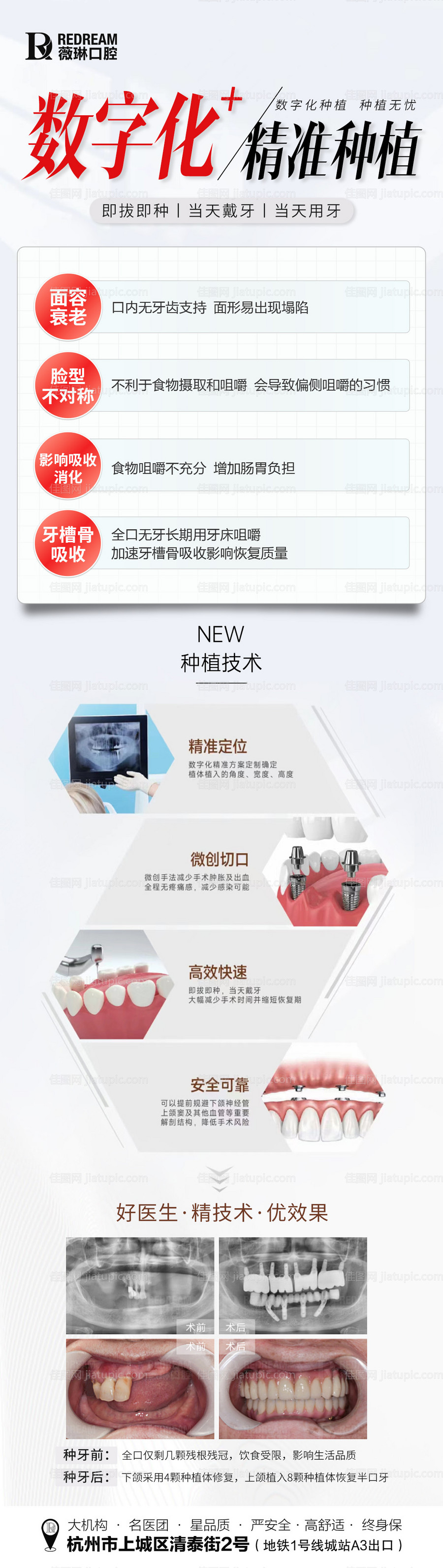 口腔种植牙长图-源文件