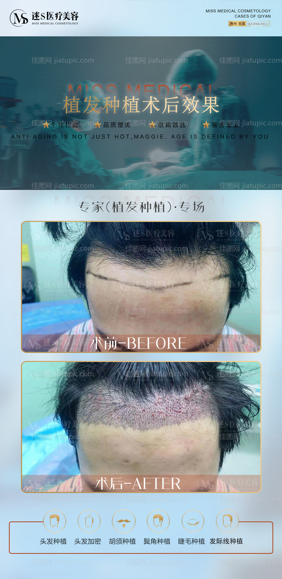 植发发际线鬓角案例长图海报-源文件