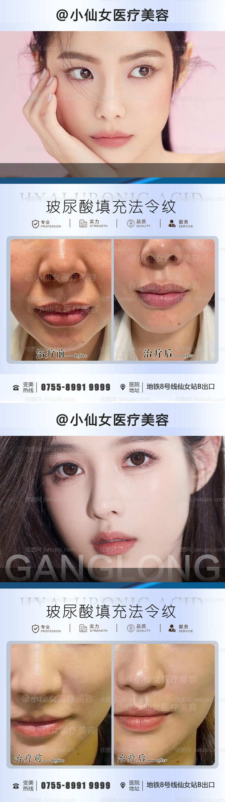玻尿酸填充案例海报-源文件