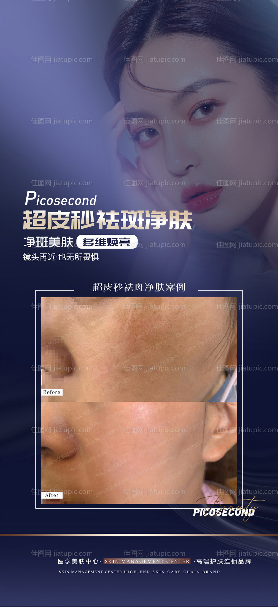 医美超皮秒祛斑科普宣传海报-源文件