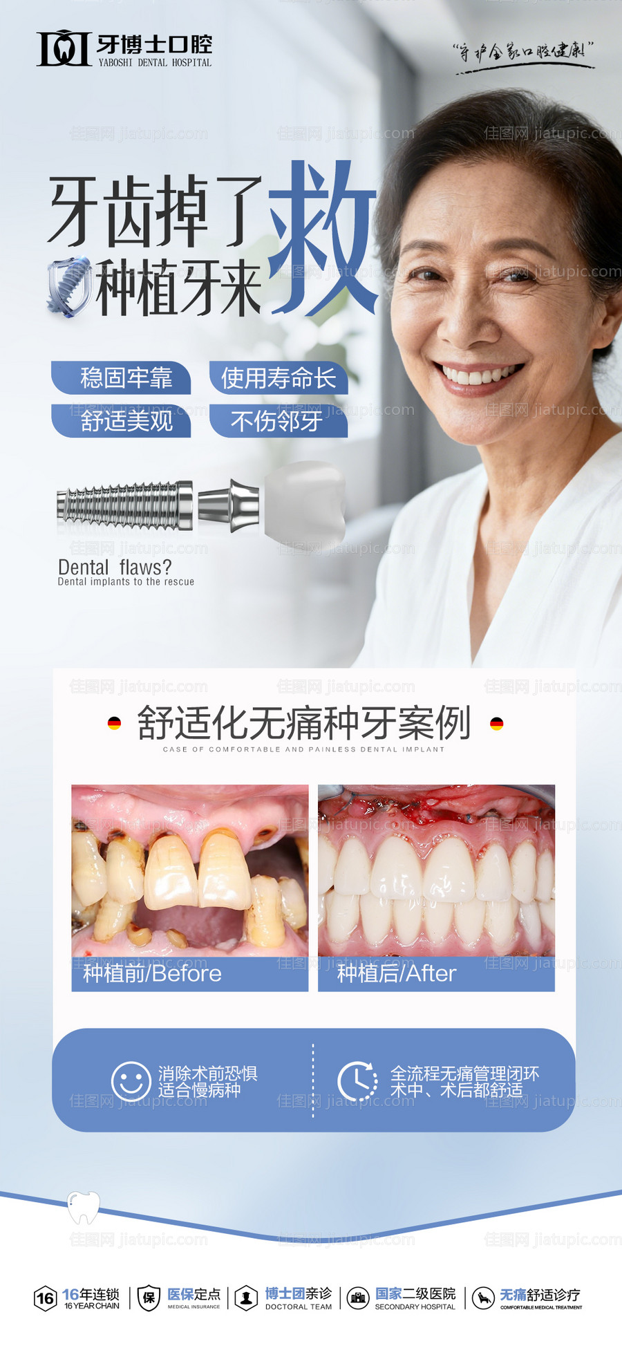 种植牙案例海报-源文件