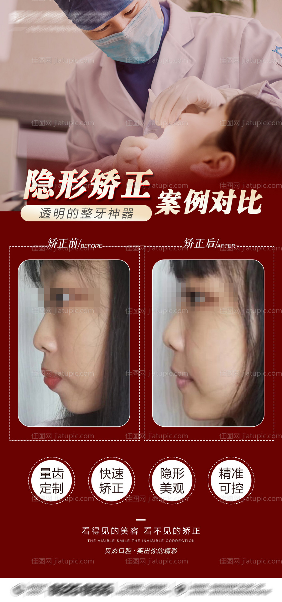 口腔隐形矫正案例海报-源文件