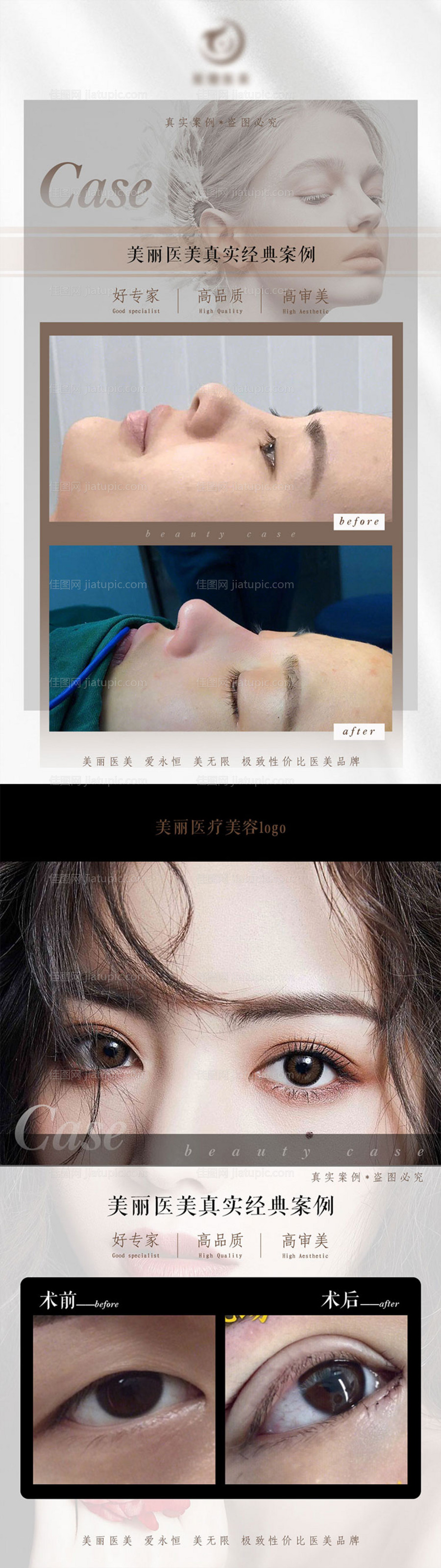 医美案例朋友圈宣传海报-源文件