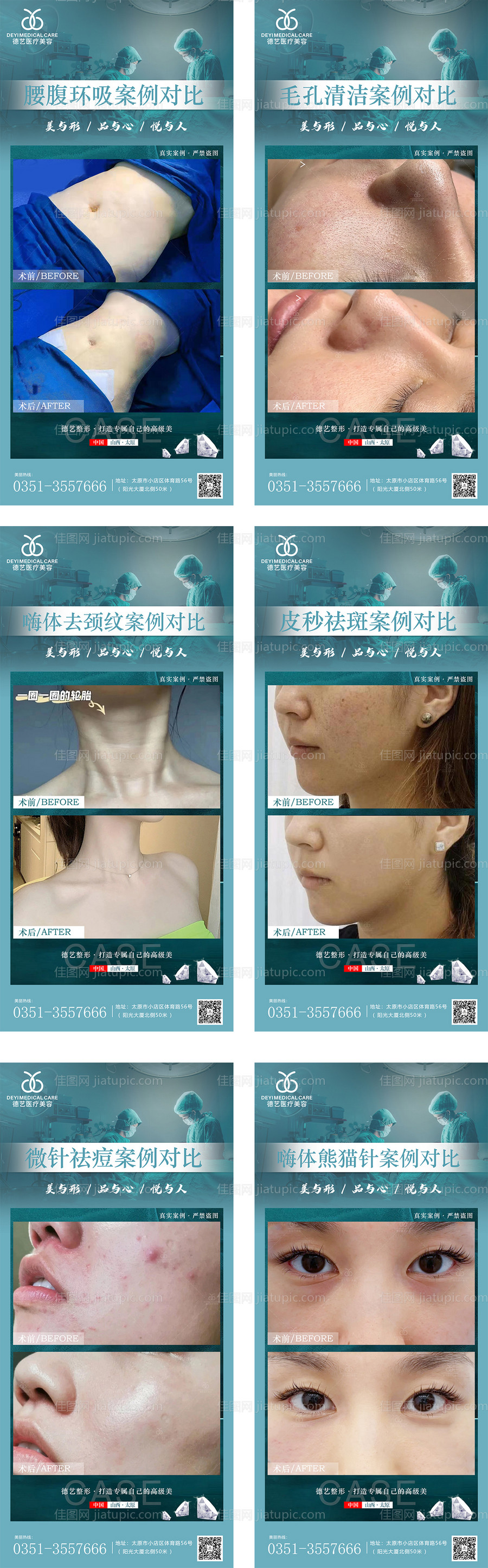 医美案例对比图-源文件