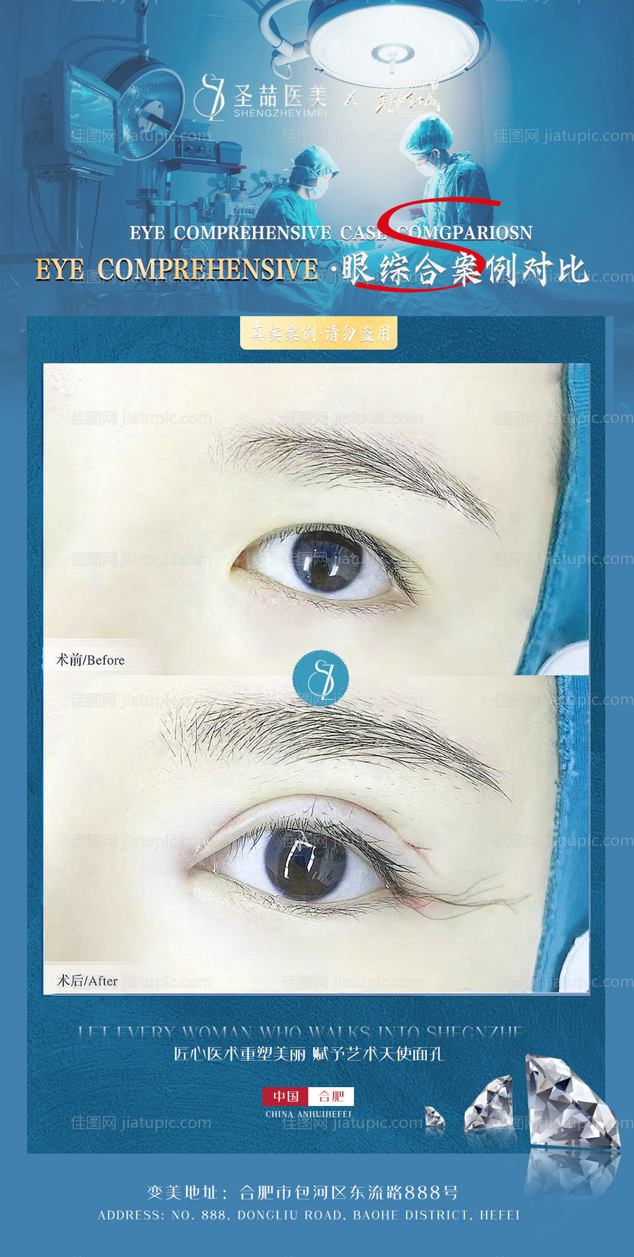医美整形案例海报-源文件