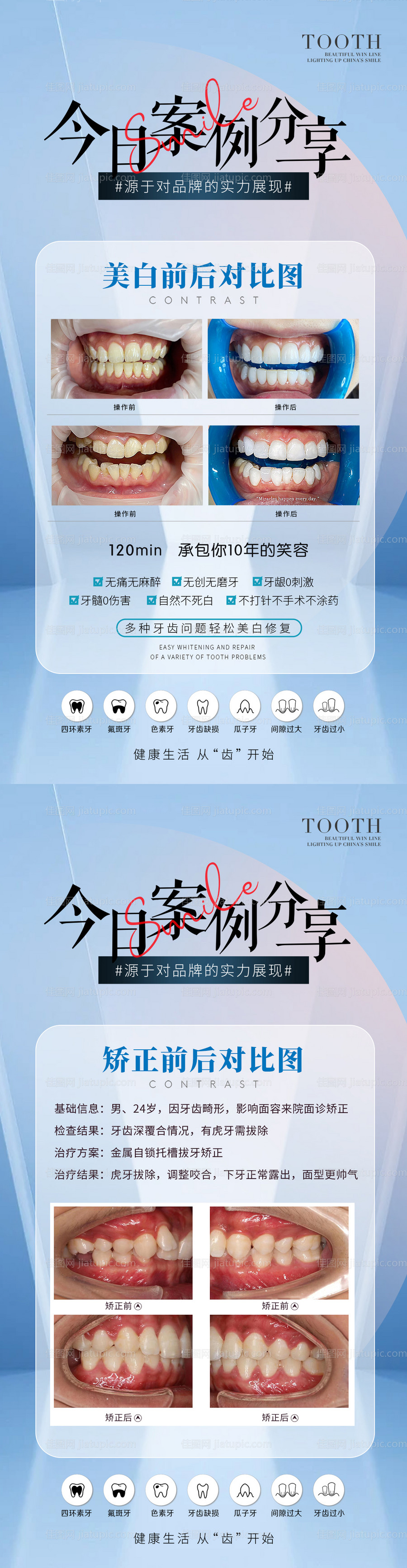 医疗牙齿美白矫正案例-源文件